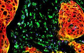 Bladder Transitional Cell Carcinoma: CD163, PD-L1, PanCK, CD68 20x